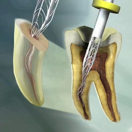 Everybody can treat root canals, but...