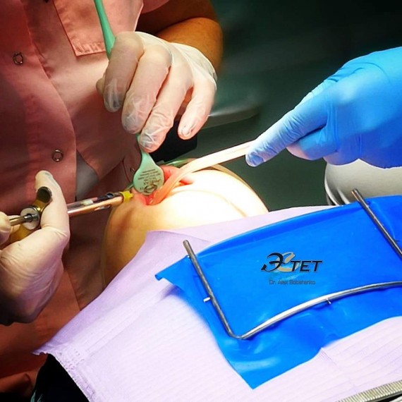 Dental anesthetic carpules